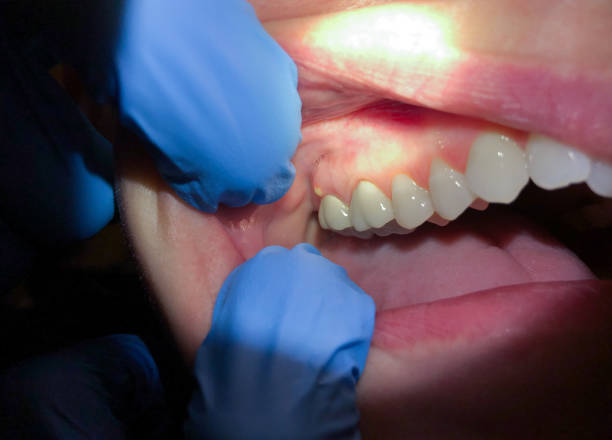 Best Emergency Broken Tooth Repair in Waupaca, WI